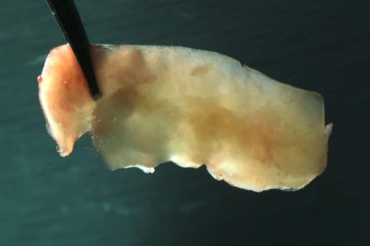 Connective tissue graft, easy to harvest and predictable