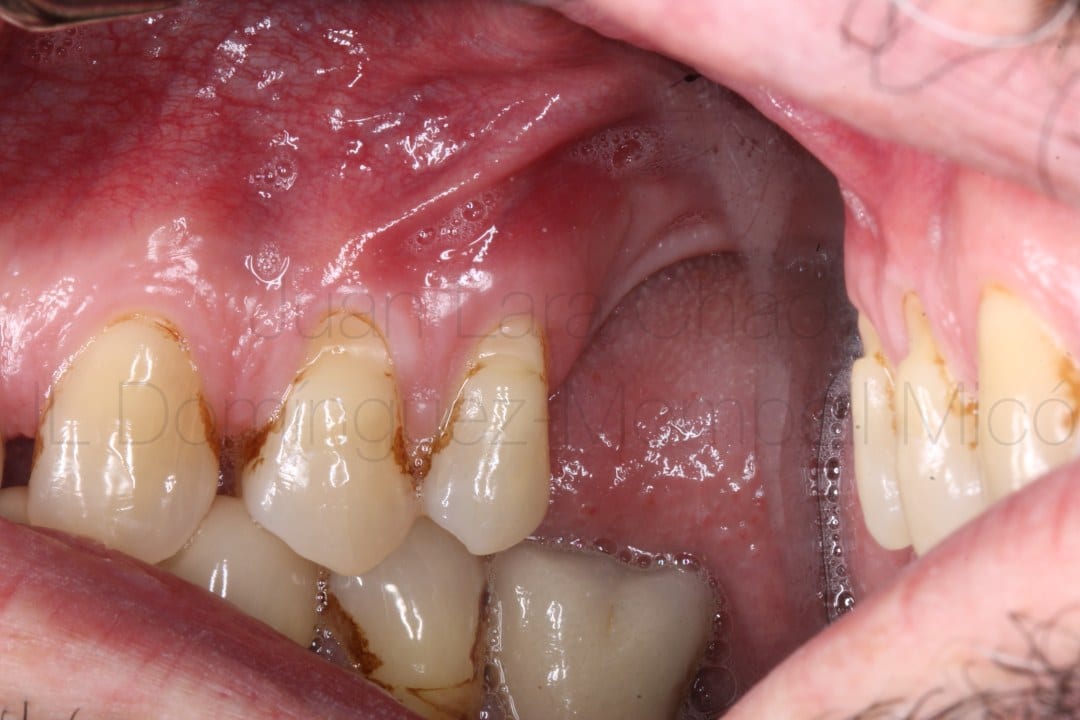 vertical bone reconstruction in posterior maxilla