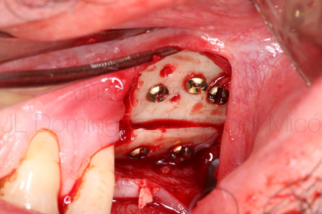 vertical bone reconstruction in posterior maxilla