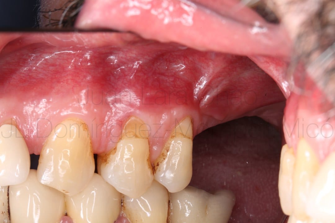 vertical bone reconstruction in posterior maxilla