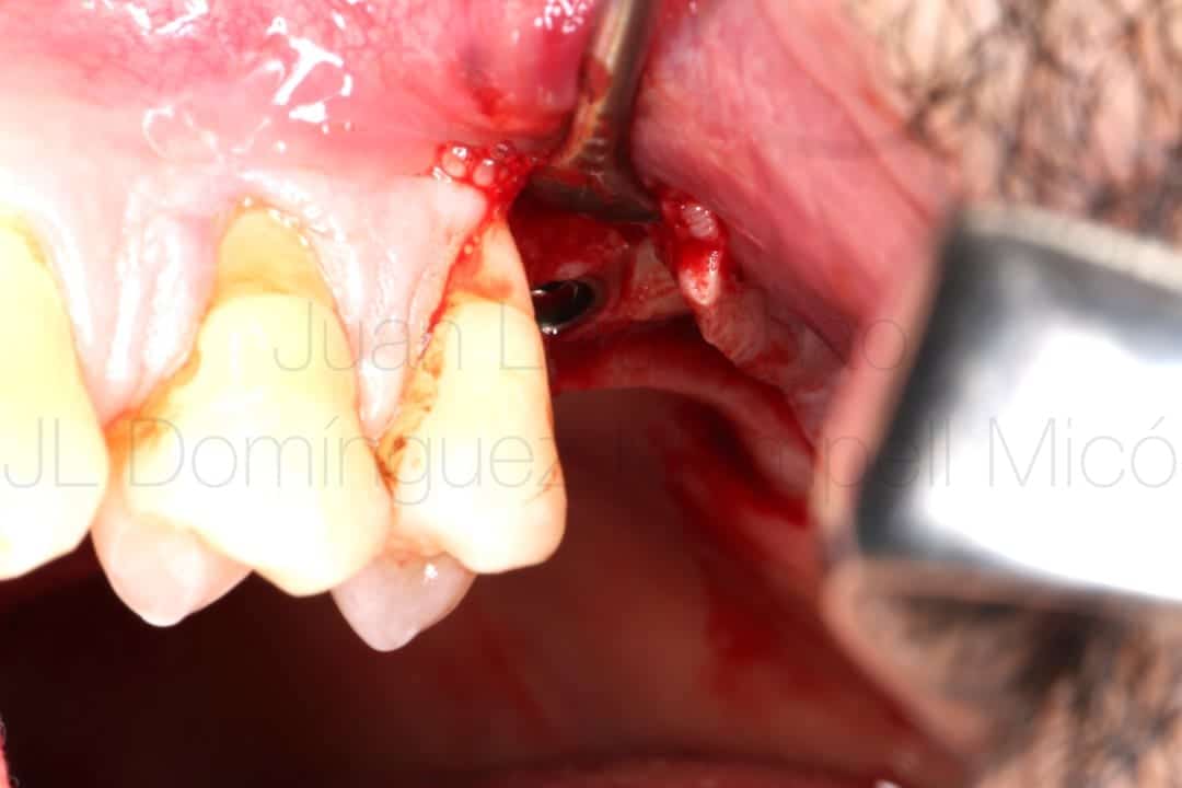 vertical bone reconstruction in posterior maxilla