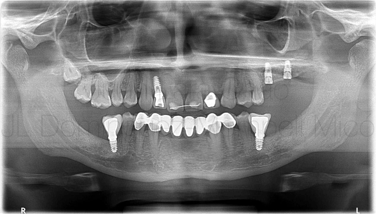 vertical bone reconstruction in posterior maxilla