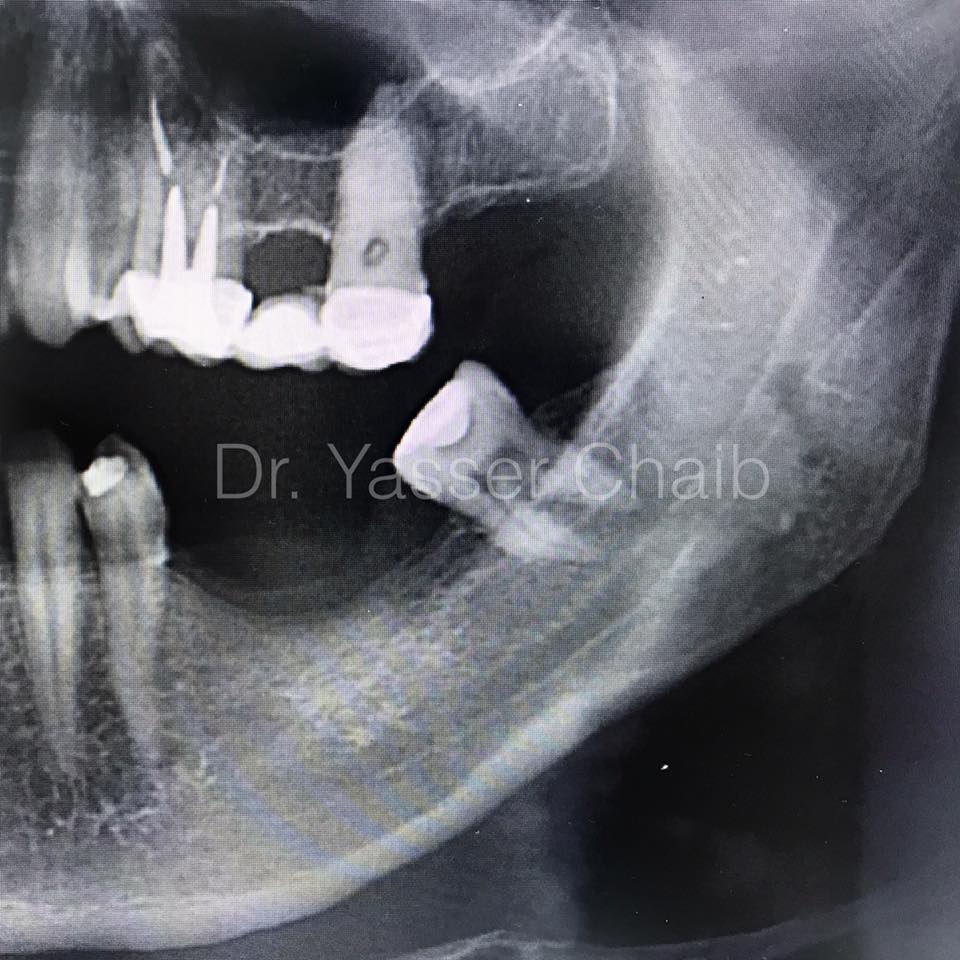 posterior mandible reconstruction