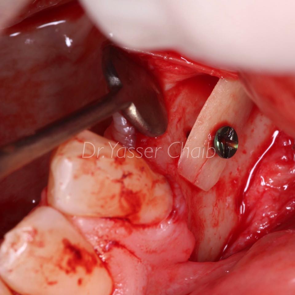 posterior mandible reconstruction