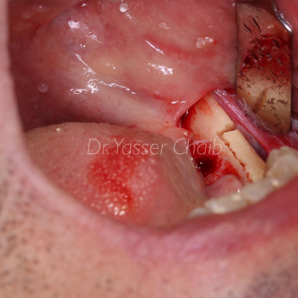 posterior mandible reconstruction