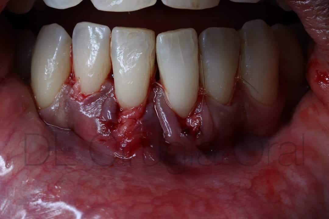 connective tissue graft for recessions