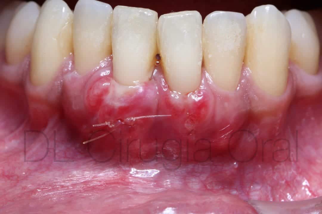 connective tissue graft for recessions