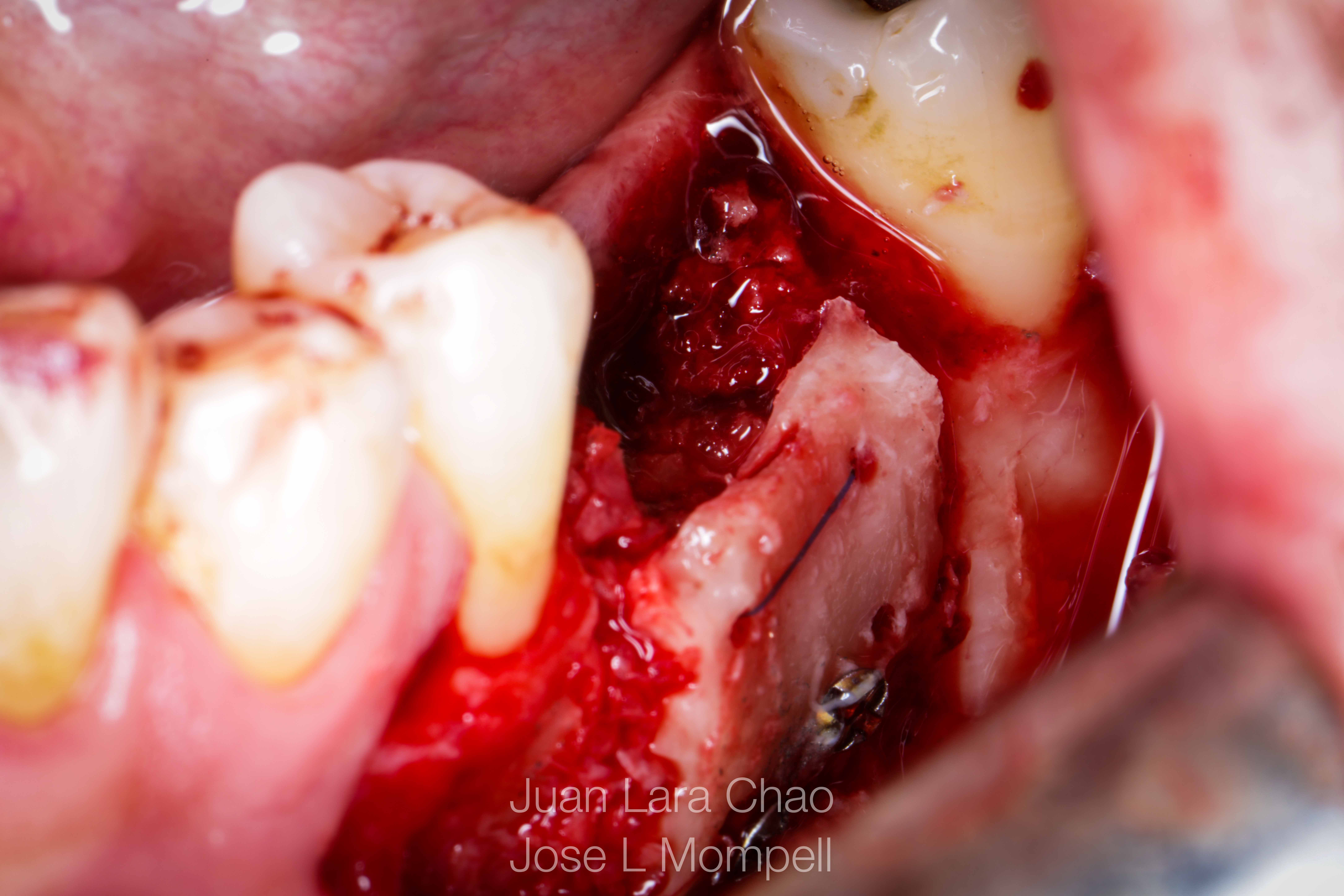 how to remove a fractured implant