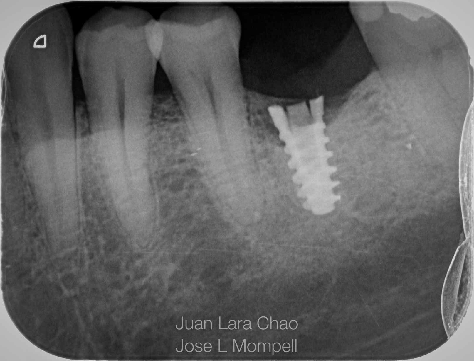 how to remove a fractured implant