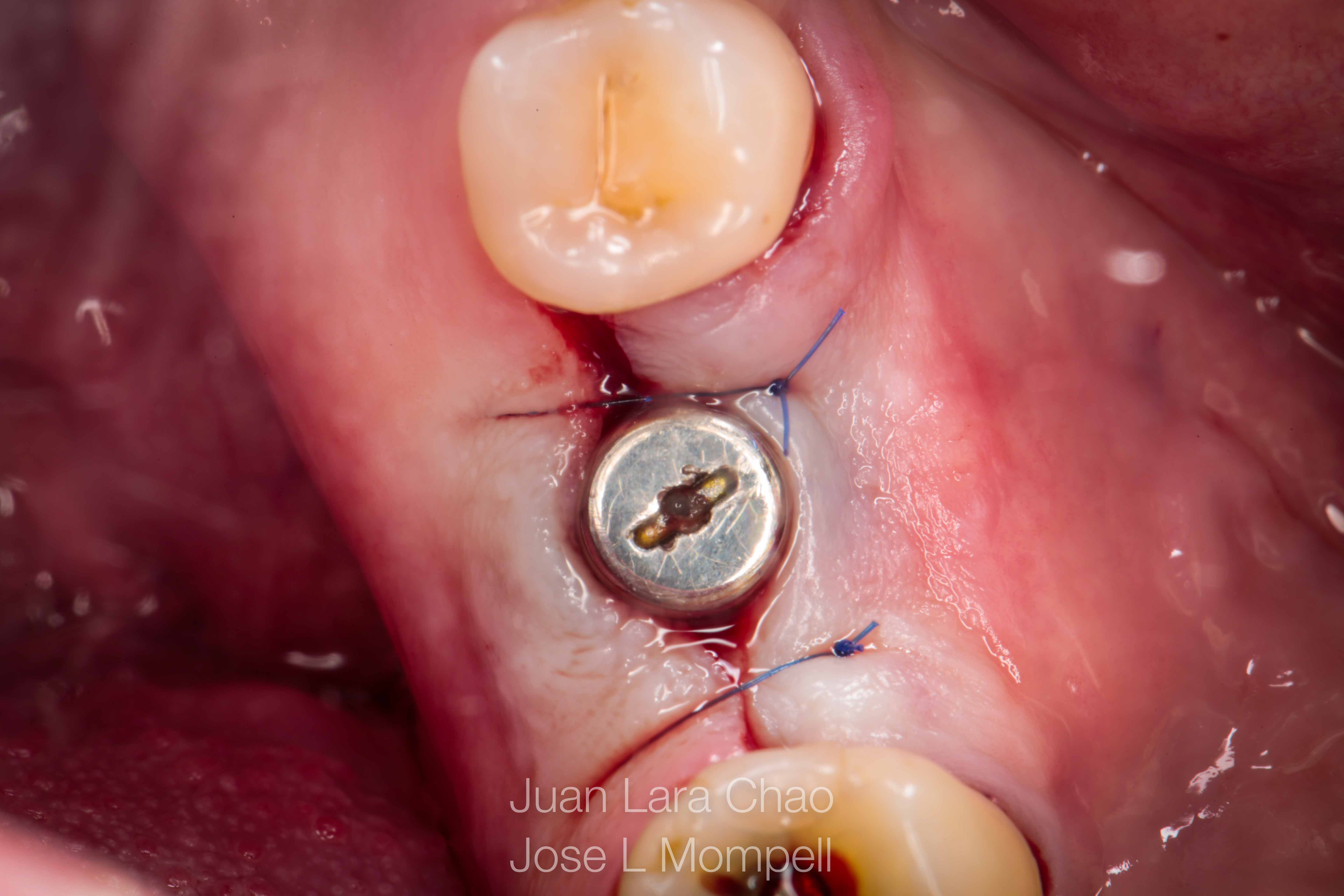 how to remove a fractured implant