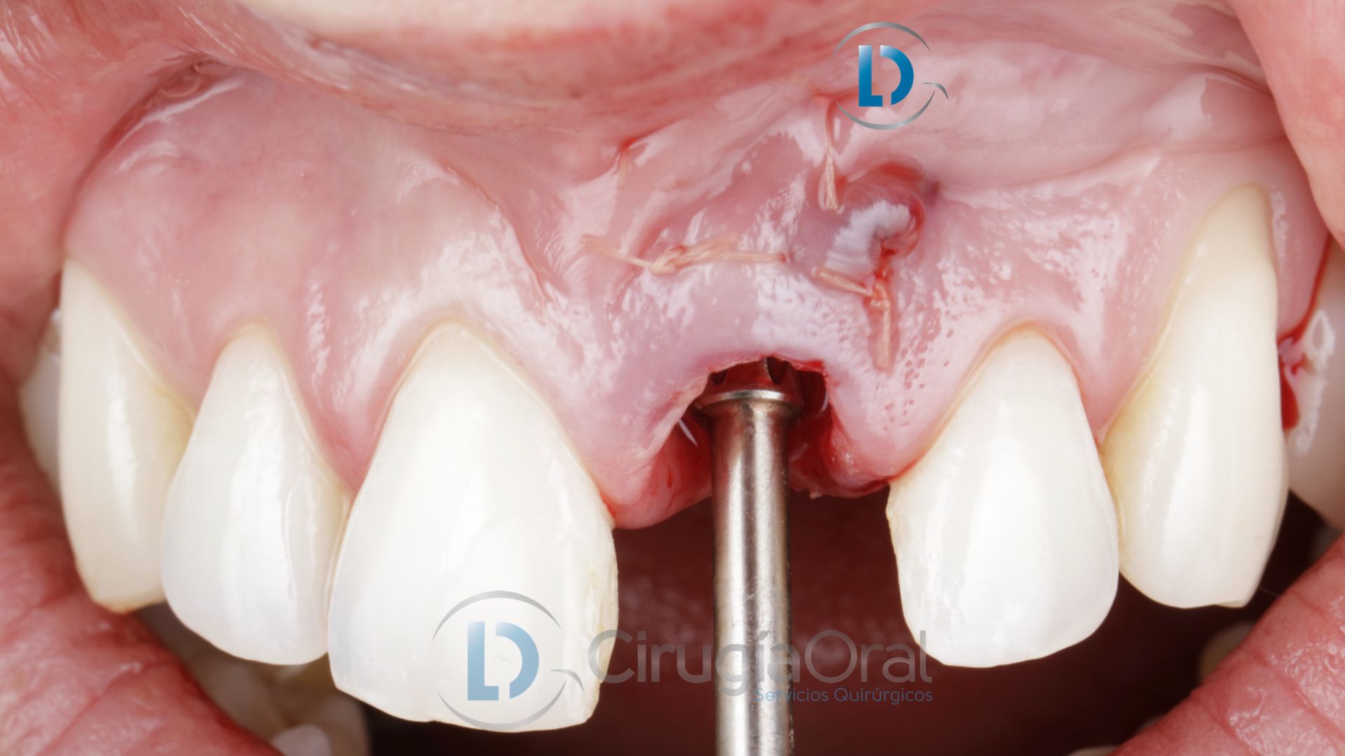 Dental implant in the aesthetic zone