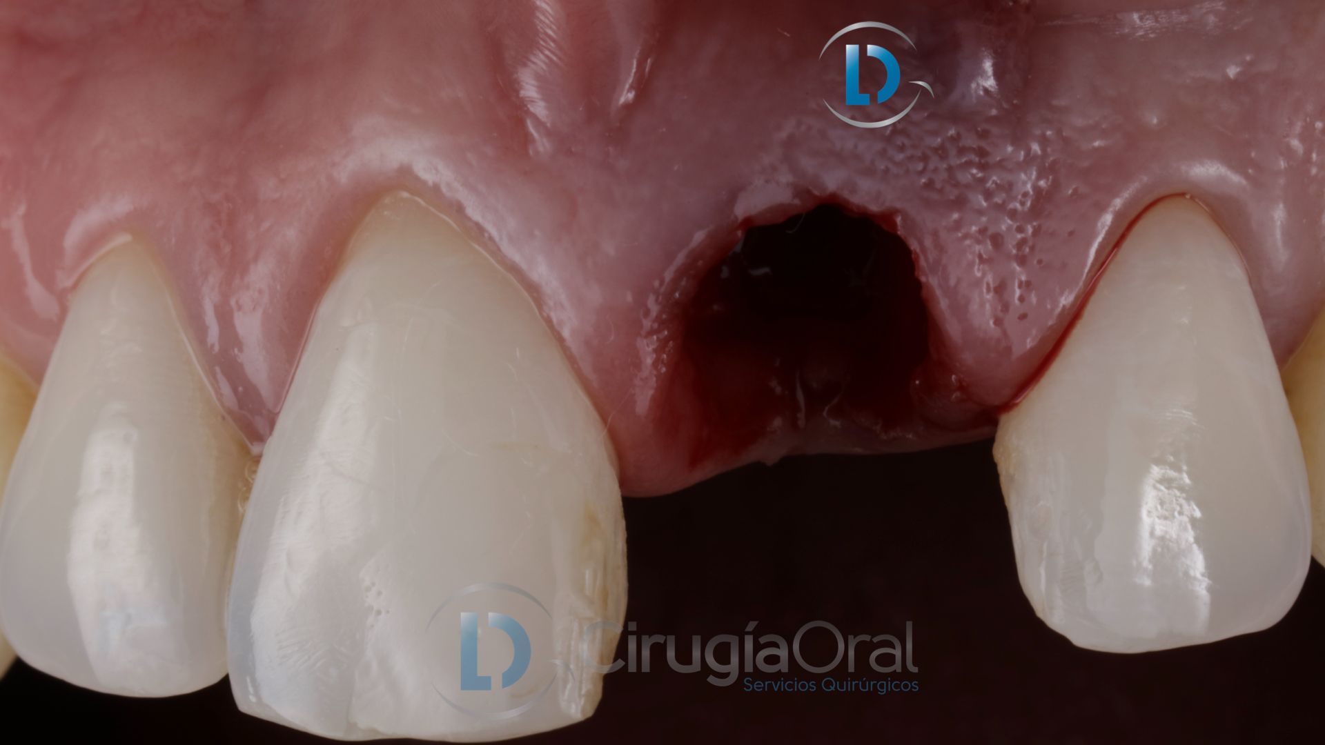 Dental implant in the aesthetic zone