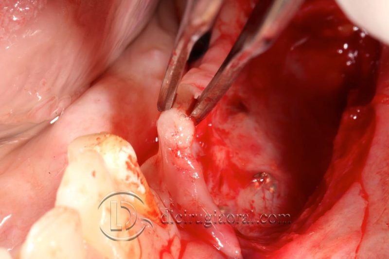 Kazanjian Vestibuloplasty – Indications and Surgical Protocol