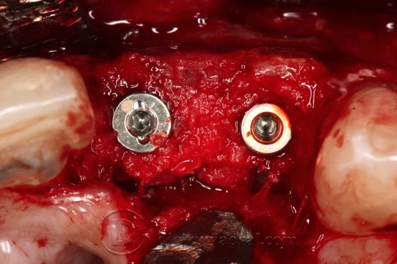 Implant surgery on reconstruction on front part