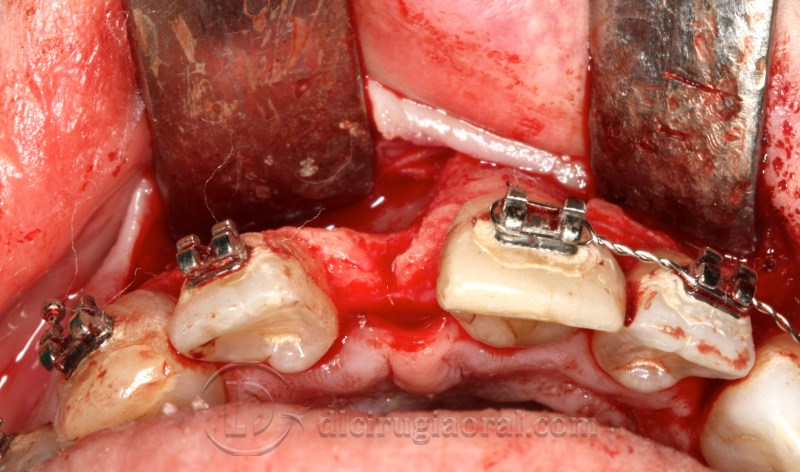 Atrophy in central incisor