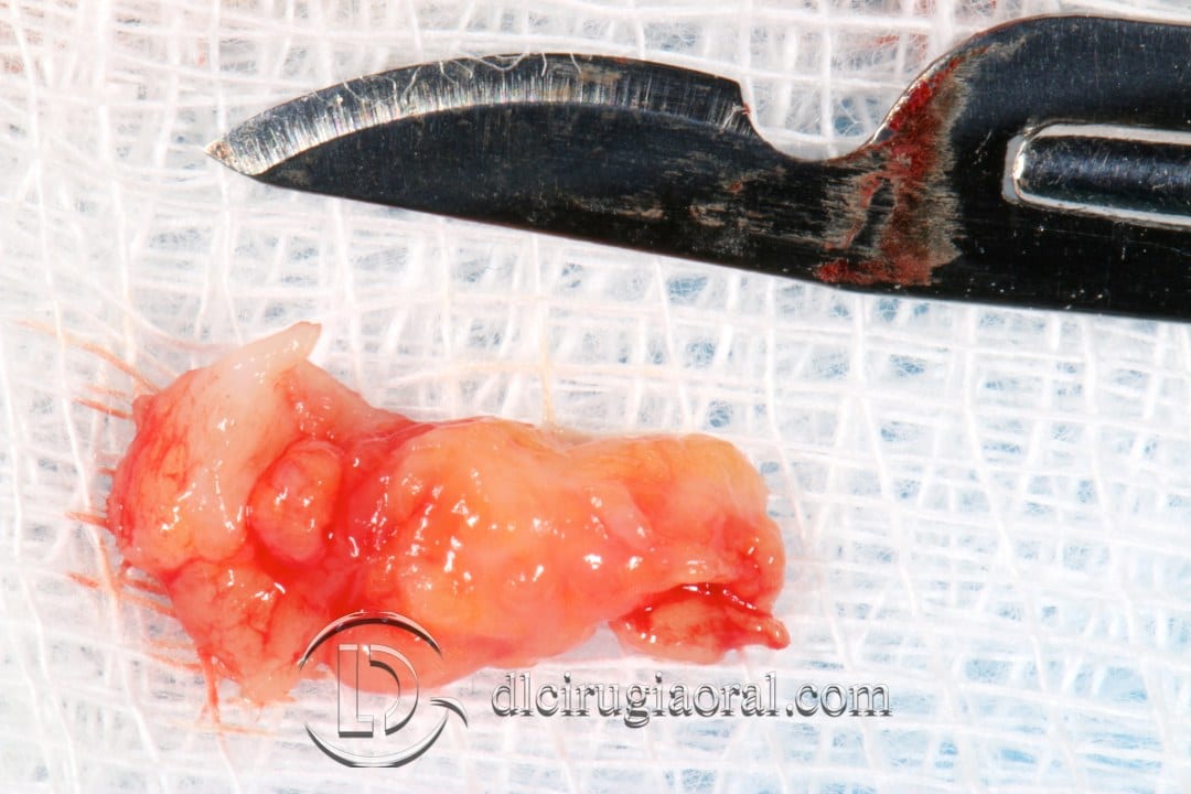 Anterior section: Post-extraction implant + Connective tissue graft
