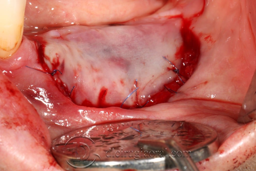 Vestibuloplasty + Implant in one surgery
