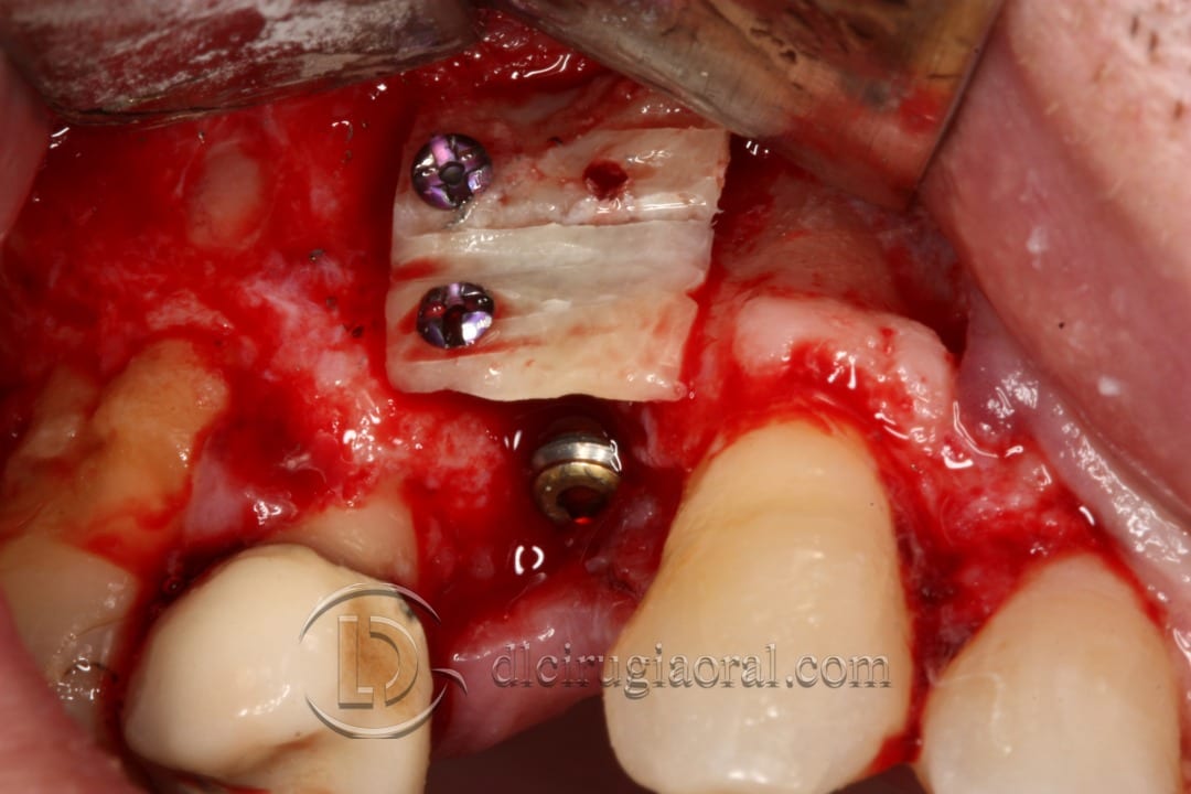 Horizontal defect in upper molar