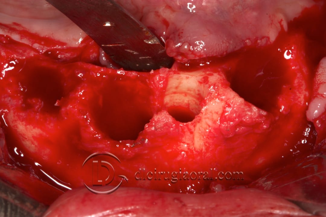 Lower overdenture: explantation and implantation