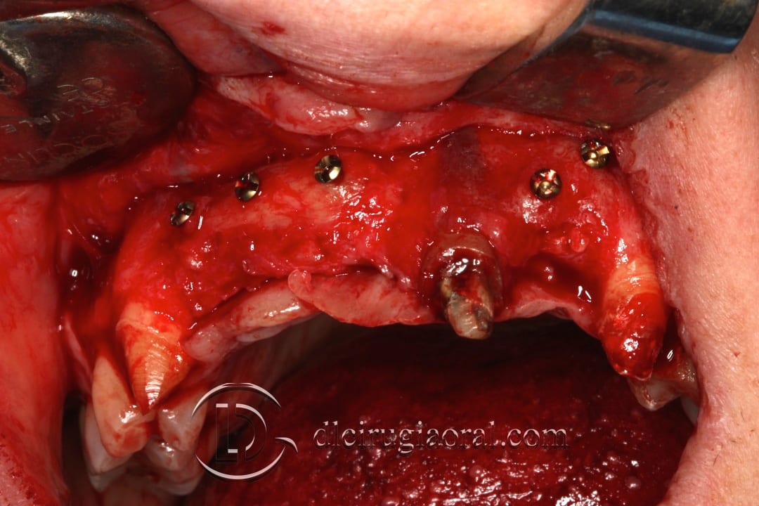 Anterior section: Placement of implants 4 months after reconstruction
