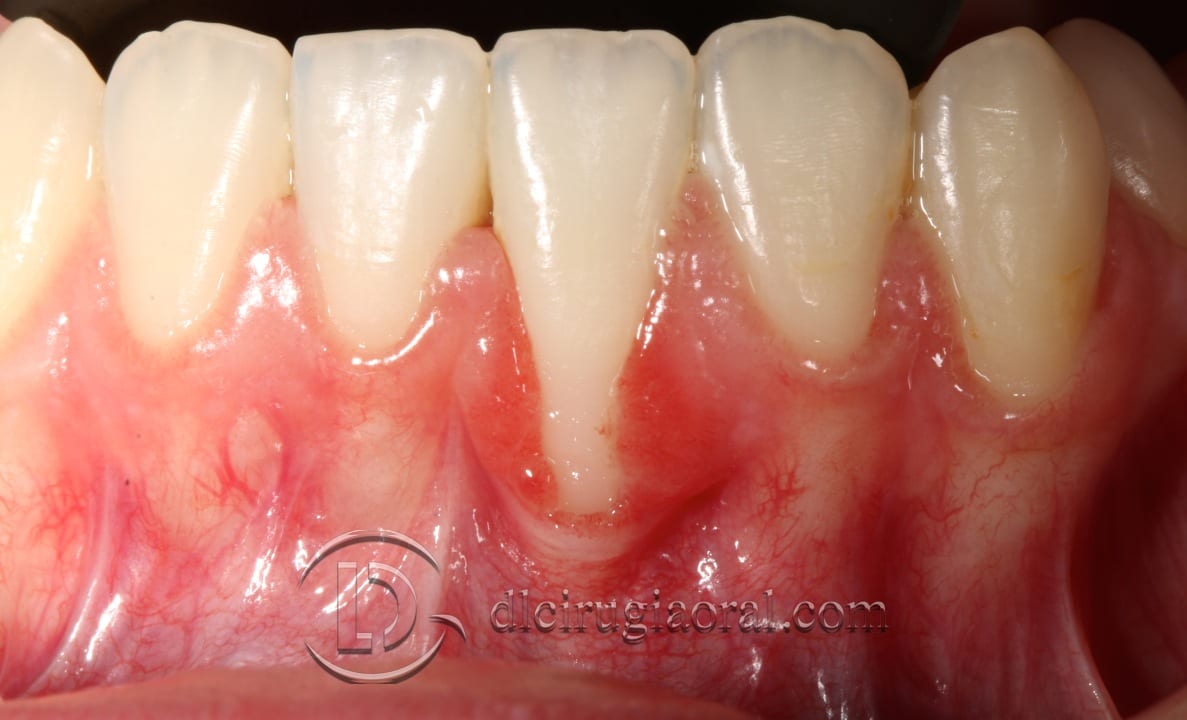 Recession: Frenectomy and tunnelled connective graft