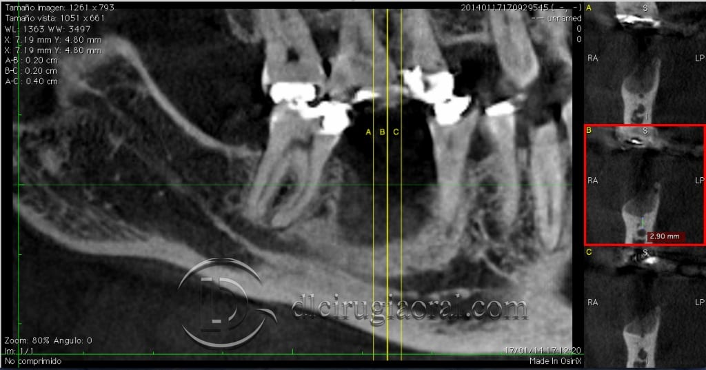 Reconstruction of vertical bone defect in the mandible