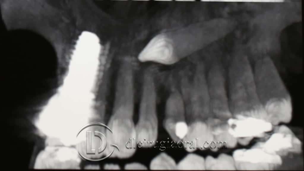 Impacted canine: extraction + implant + graft