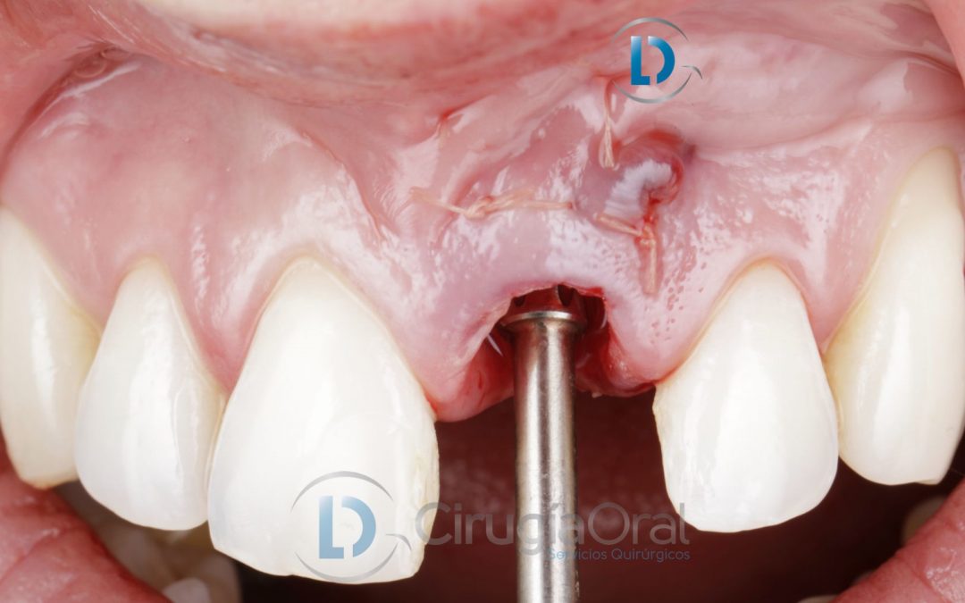 Dental implant in the aesthetic zone: Bone graft + Soft tissue + Immediate loading